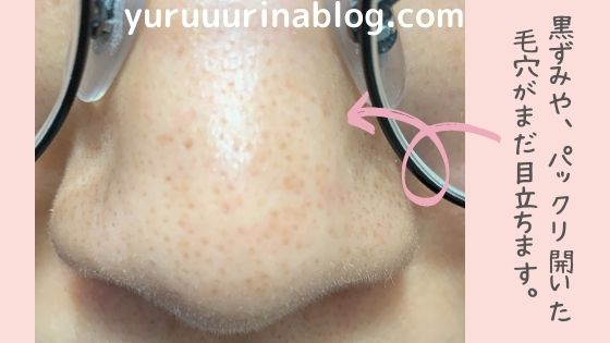 毛穴パックは良くないの 鼻パックを使い続けて後悔した話 ゆるりなゆりなのブログ